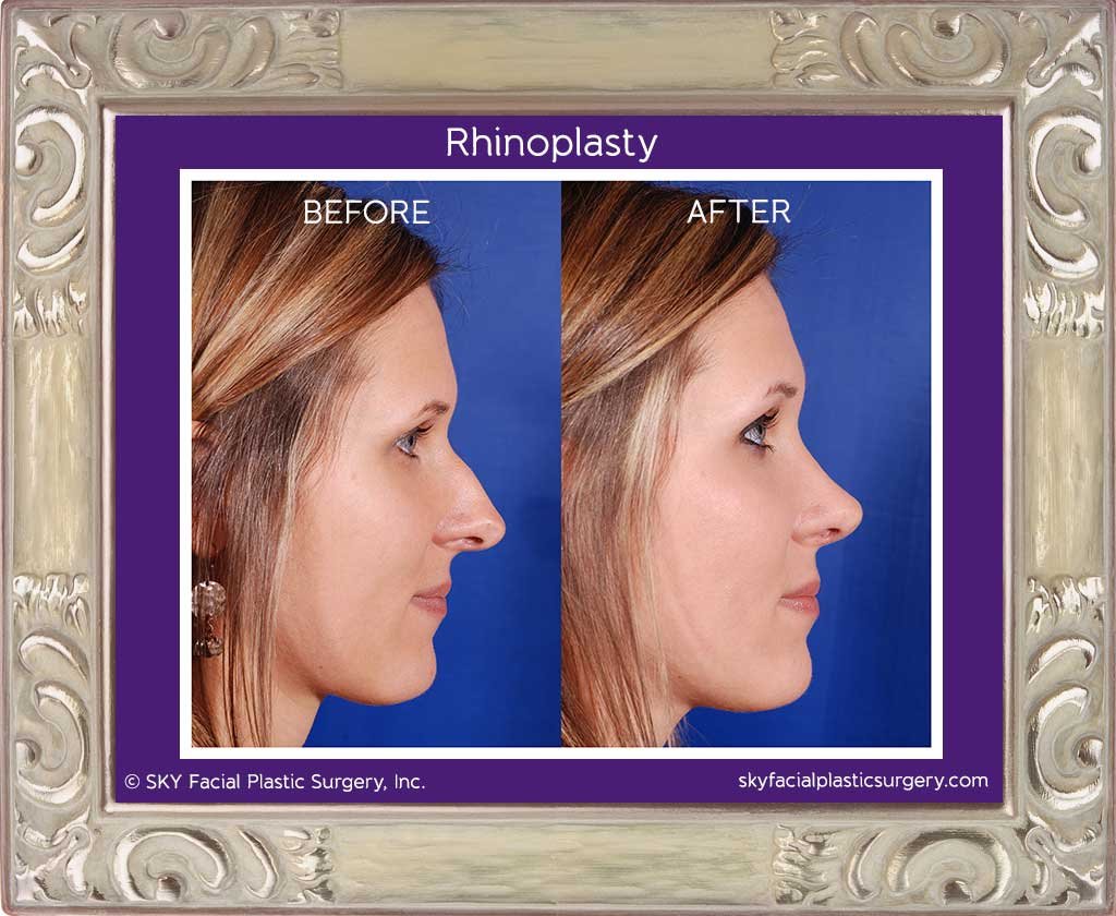 SKY-Facial-Plastic-Surgery-Rhinoplasty-1E.jpg