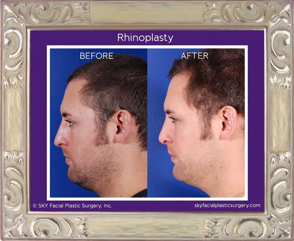 SKY-Facial-Plastic-Surgery-Rhinoplasty-3A.jpg