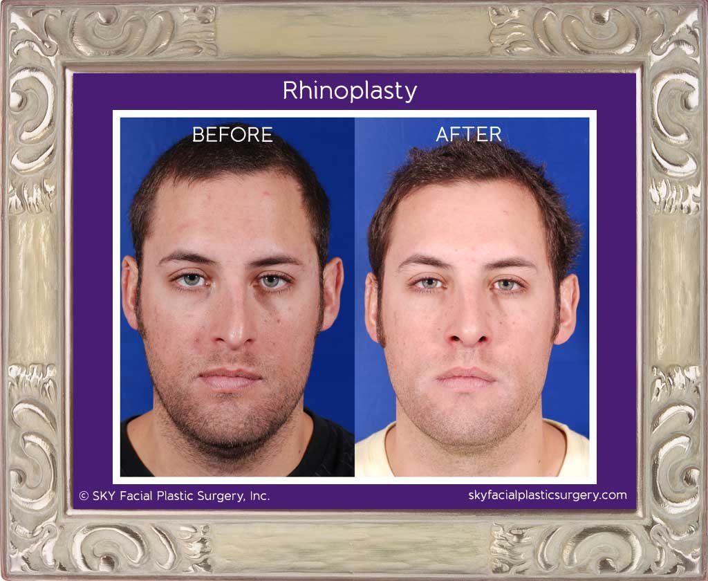 SKY-Facial-Plastic-Surgery-Rhinoplasty-3C.jpg