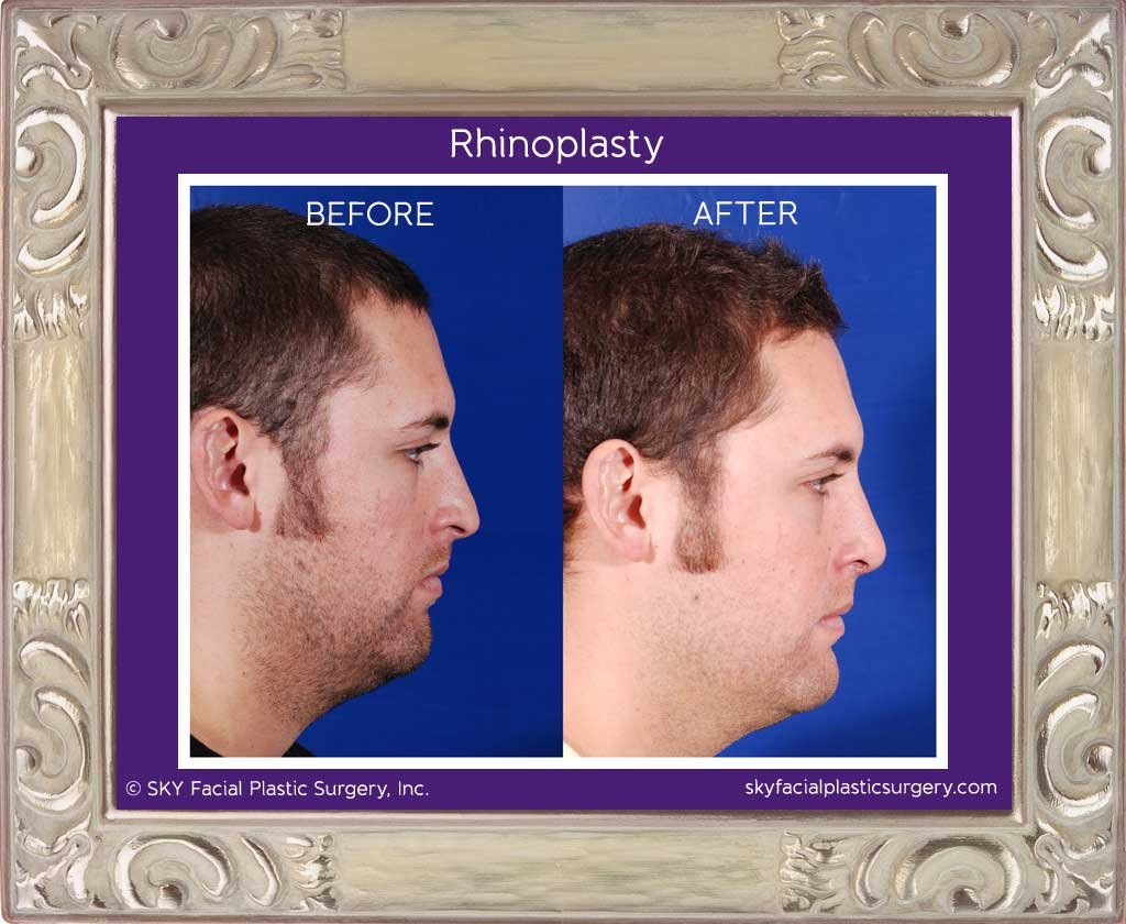 SKY-Facial-Plastic-Surgery-Rhinoplasty-3E.jpg