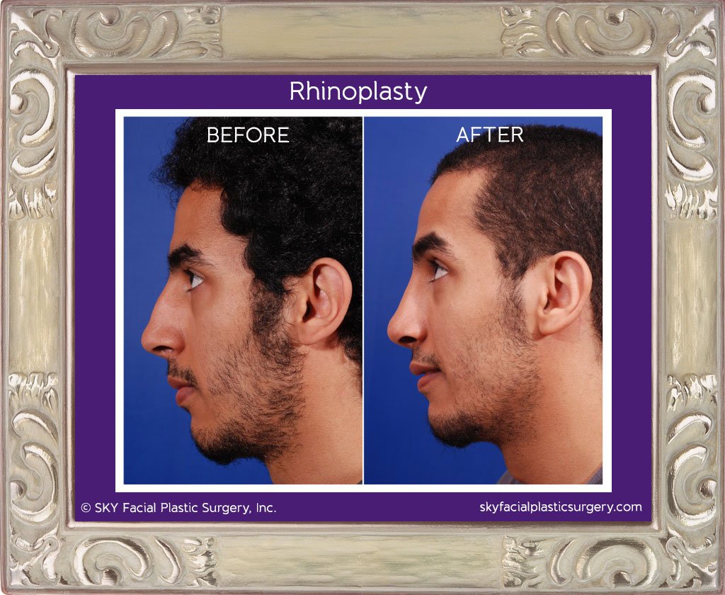 SKY-Facial-Plastic-Surgery-Rhinoplasty-4A.jpg