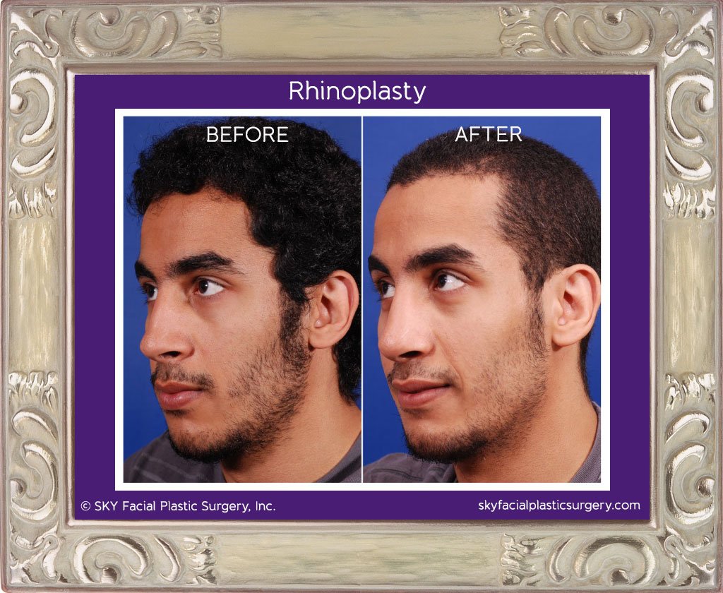 SKY-Facial-Plastic-Surgery-Rhinoplasty-4B.jpg