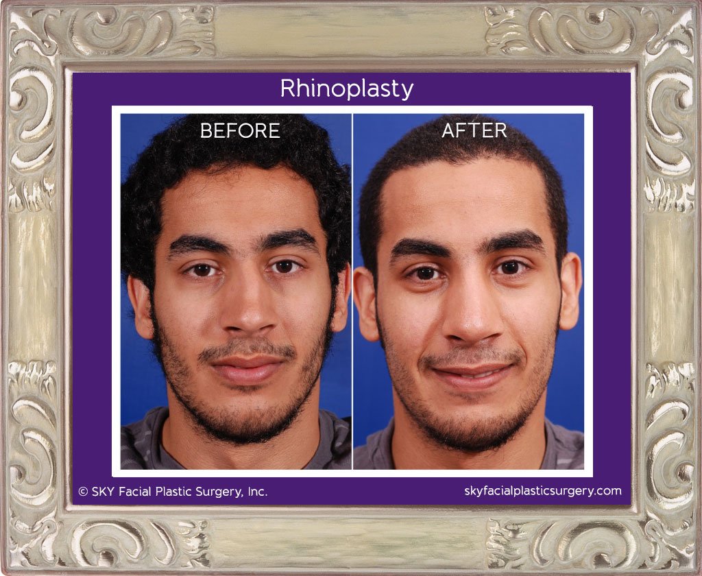 SKY-Facial-Plastic-Surgery-Rhinoplasty-4C.jpg