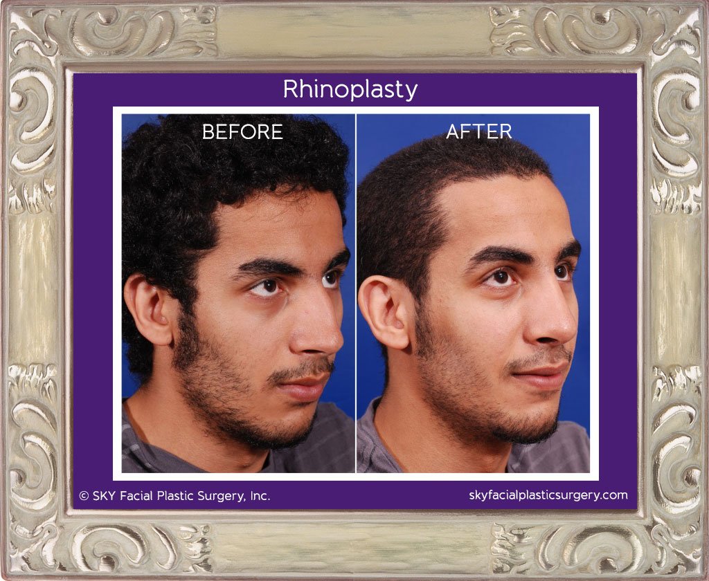 SKY-Facial-Plastic-Surgery-Rhinoplasty-4D.jpg