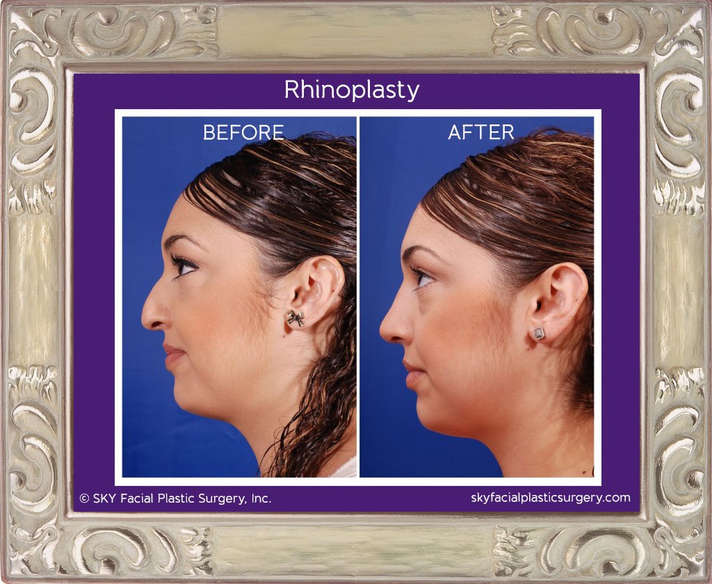 SKY-Facial-Plastic-Surgery-Rhinoplasty-5A.jpg