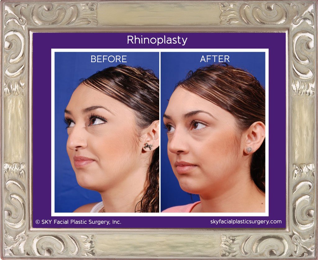 SKY-Facial-Plastic-Surgery-Rhinoplasty-5B.jpg