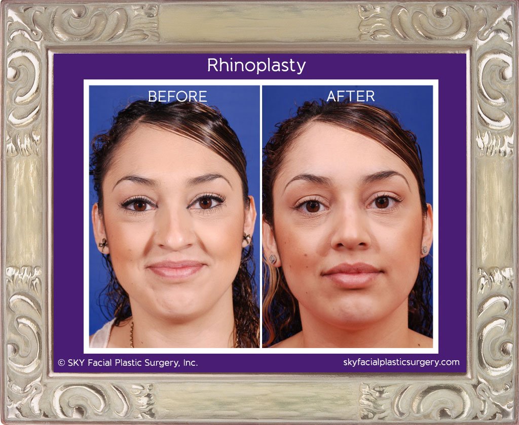 SKY-Facial-Plastic-Surgery-Rhinoplasty-5C.jpg