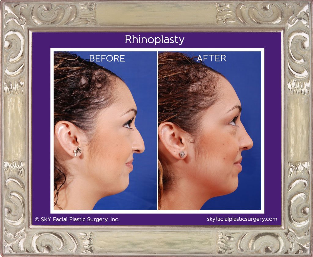 SKY-Facial-Plastic-Surgery-Rhinoplasty-5E.jpg