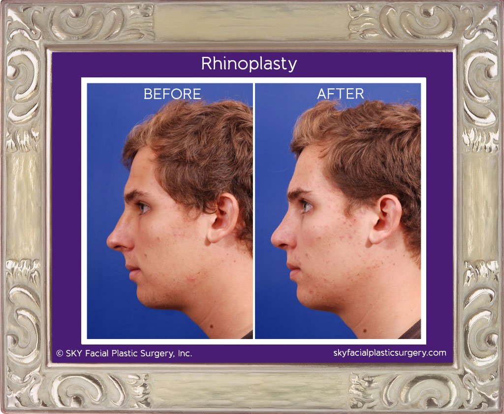 SKY-Facial-Plastic-Surgery-Rhinoplasty-6A.jpg