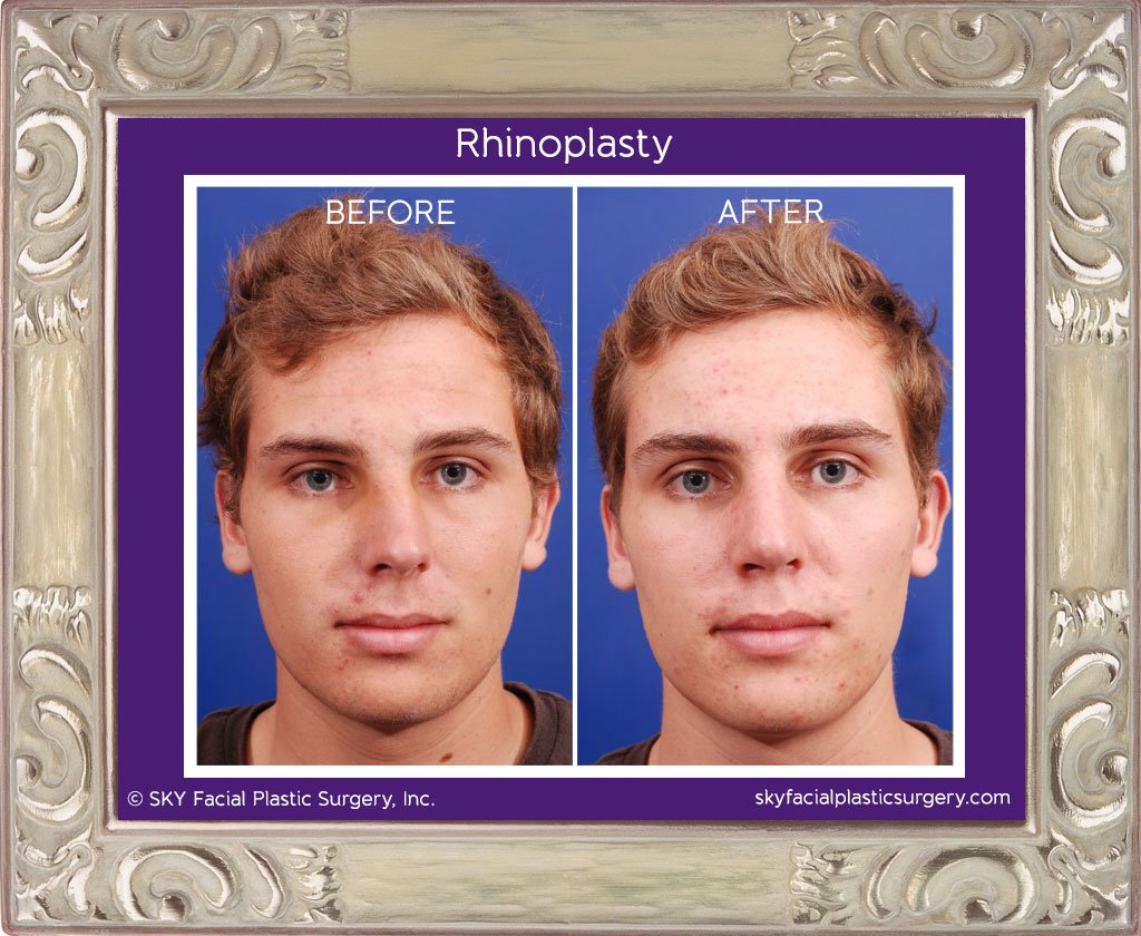 SKY-Facial-Plastic-Surgery-Rhinoplasty-6C.jpg