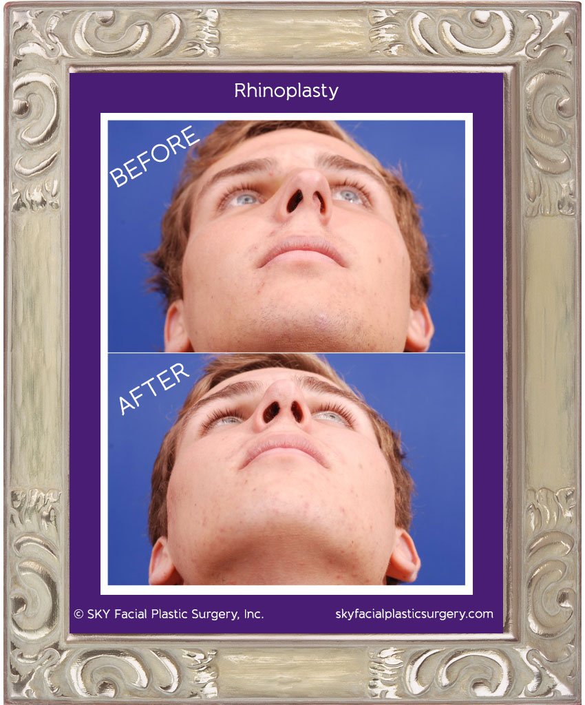 SKY-Facial-Plastic-Surgery-Rhinoplasty-6D.jpg