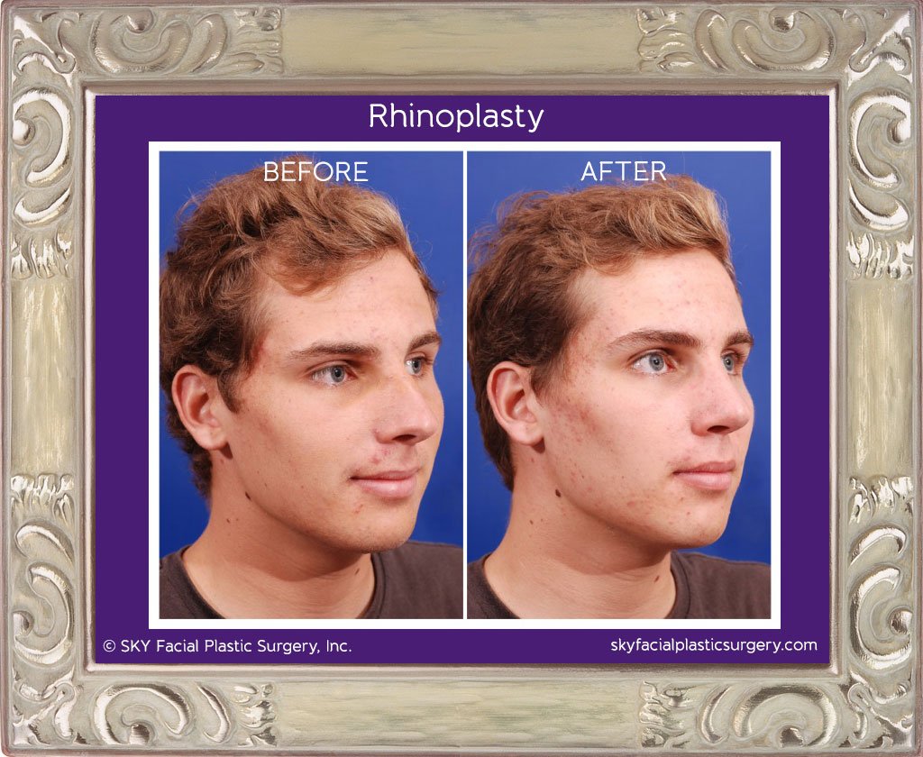 SKY-Facial-Plastic-Surgery-Rhinoplasty-6E.jpg