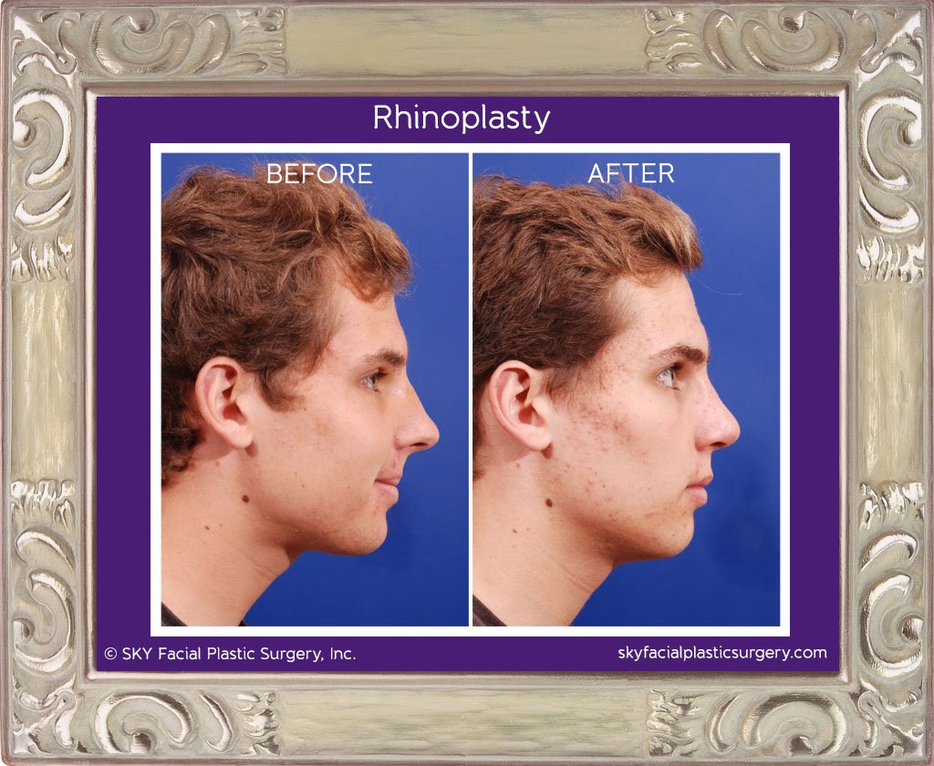SKY-Facial-Plastic-Surgery-Rhinoplasty-6F.jpg