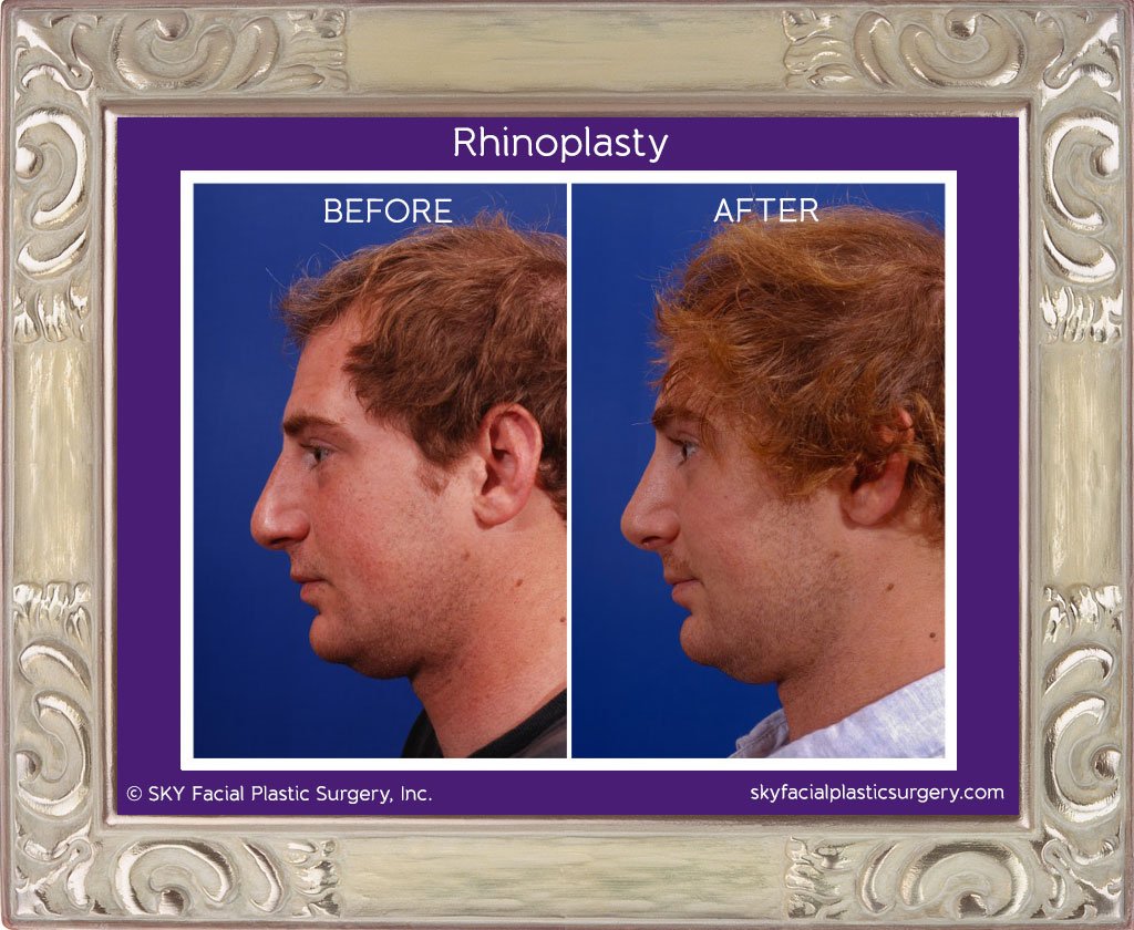 SKY-Facial-Plastic-Surgery-Rhinoplasty-7A.jpg