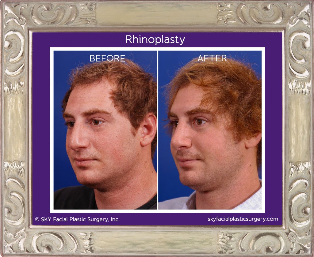 SKY-Facial-Plastic-Surgery-Rhinoplasty-7B.jpg