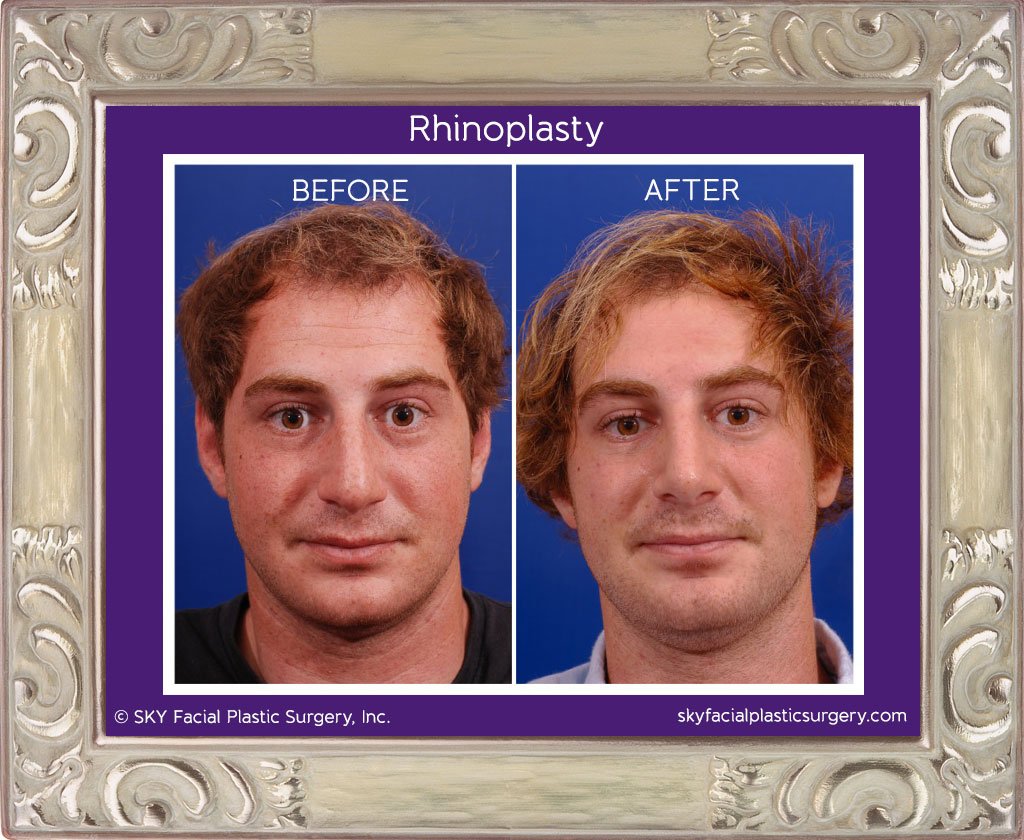 SKY-Facial-Plastic-Surgery-Rhinoplasty-7C.jpg