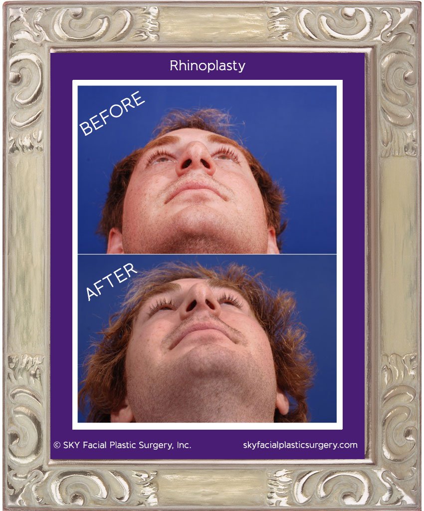 SKY-Facial-Plastic-Surgery-Rhinoplasty-7D.jpg
