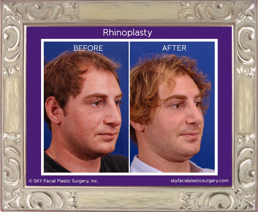 SKY-Facial-Plastic-Surgery-Rhinoplasty-7E.jpg