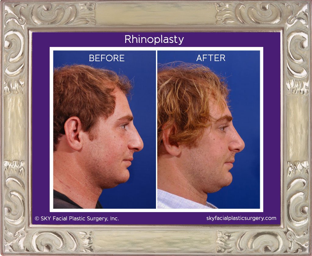 SKY-Facial-Plastic-Surgery-Rhinoplasty-7F.jpg