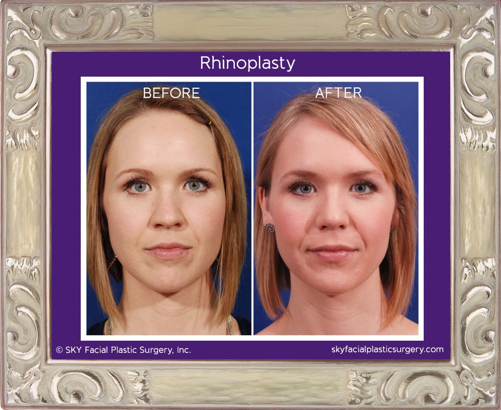 SKY-Facial-Plastic-Surgery-Rhinoplasty-8C.jpg