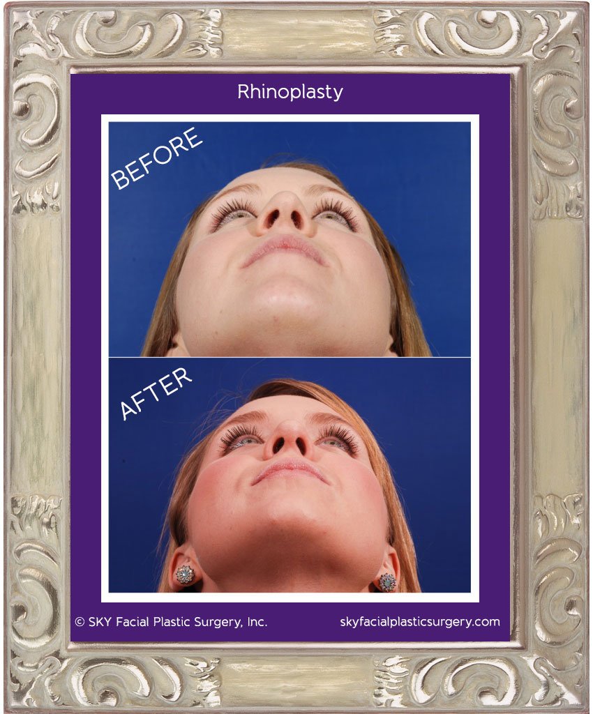 SKY-Facial-Plastic-Surgery-Rhinoplasty-8D.jpg