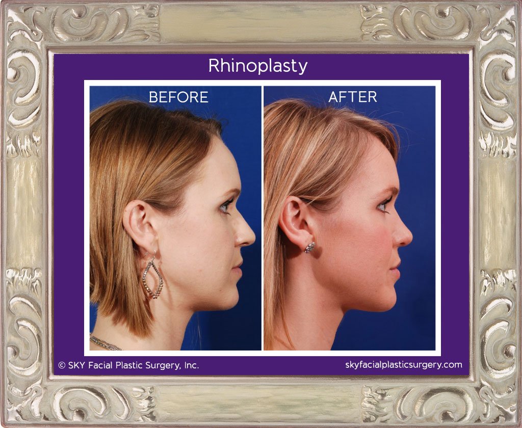 SKY-Facial-Plastic-Surgery-Rhinoplasty-8F.jpg
