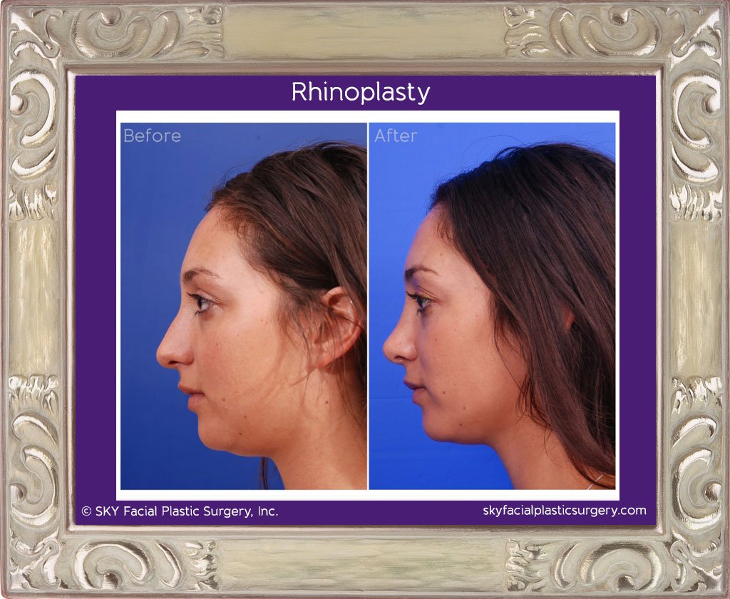 SKY-Facial-Plastic-Surgery-Rhinoplasty-9A.jpg
