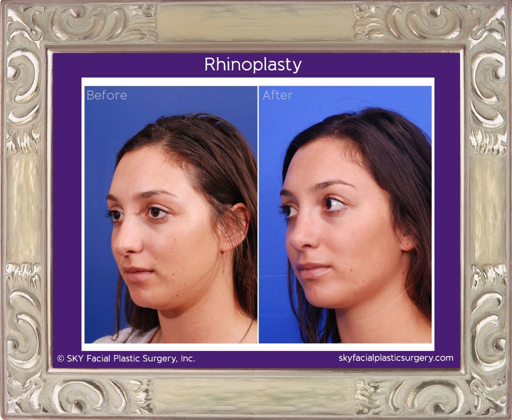 SKY-Facial-Plastic-Surgery-Rhinoplasty-9B.jpg