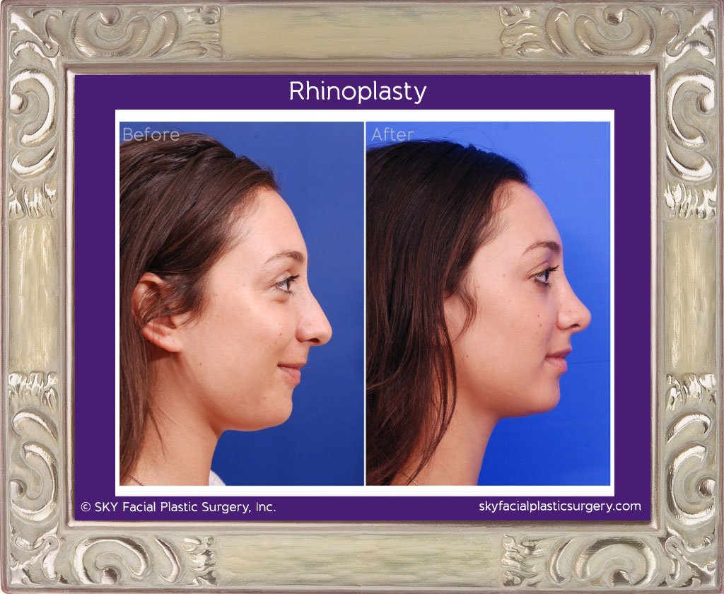 SKY-Facial-Plastic-Surgery-Rhinoplasty-9C.jpg