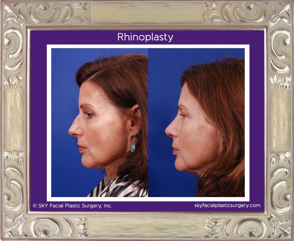 SKY-Facial-Plastic-Surgery-Rhinoplasty-10A.jpg