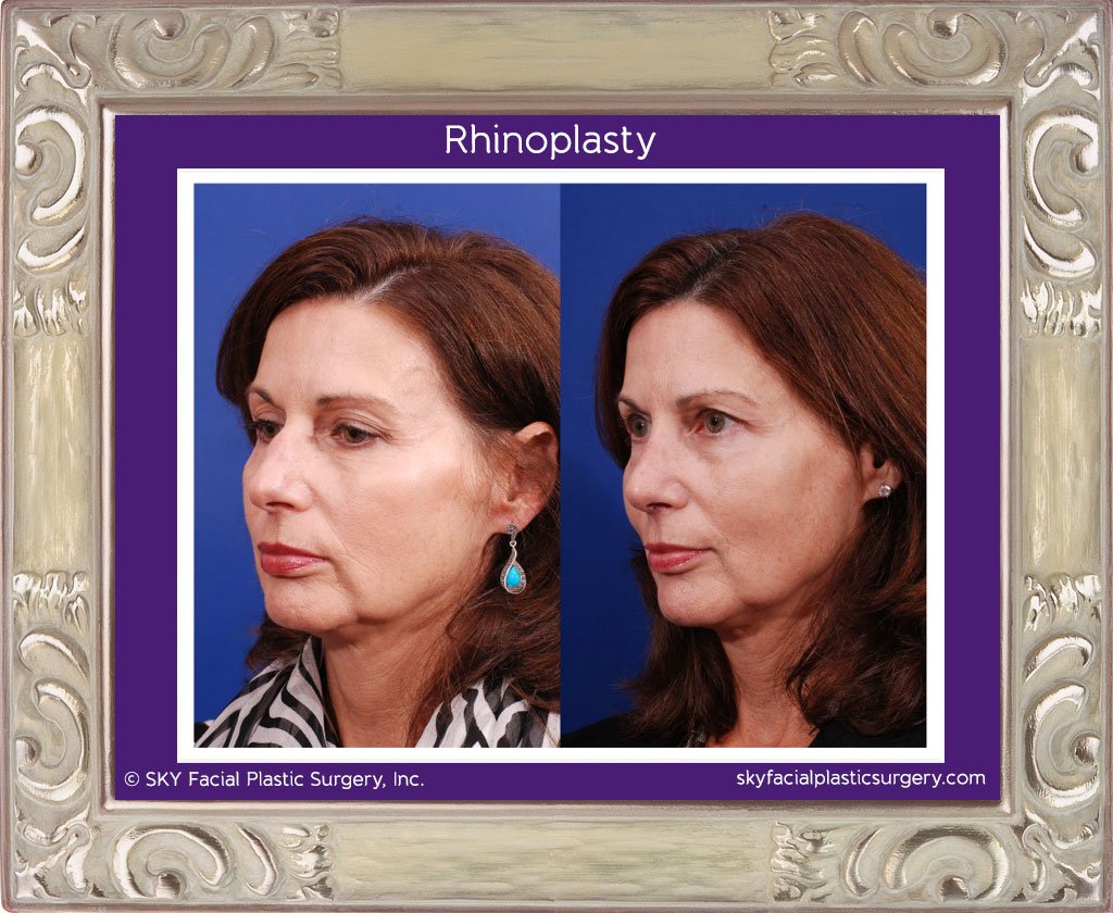 SKY-Facial-Plastic-Surgery-Rhinoplasty-10B.jpg