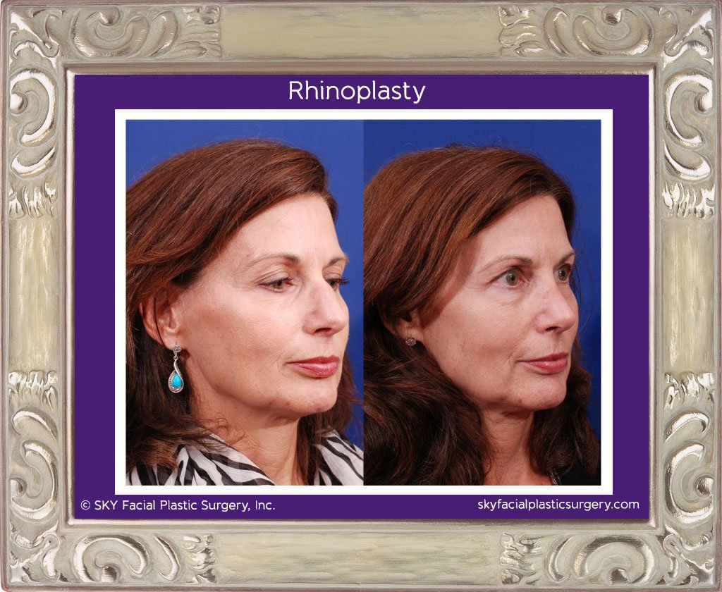 SKY-Facial-Plastic-Surgery-Rhinoplasty-10C.jpg