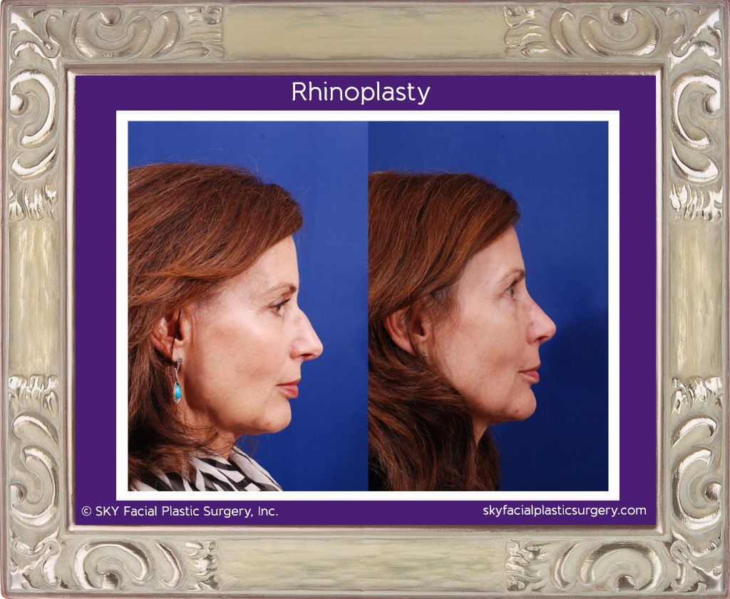 SKY-Facial-Plastic-Surgery-Rhinoplasty-10D.jpg