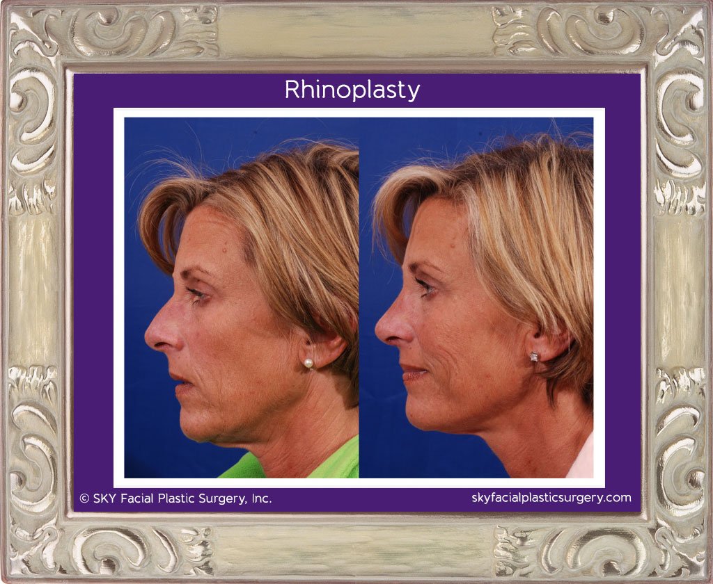 SKY-Facial-Plastic-Surgery-Rhinoplasty-11A.jpg