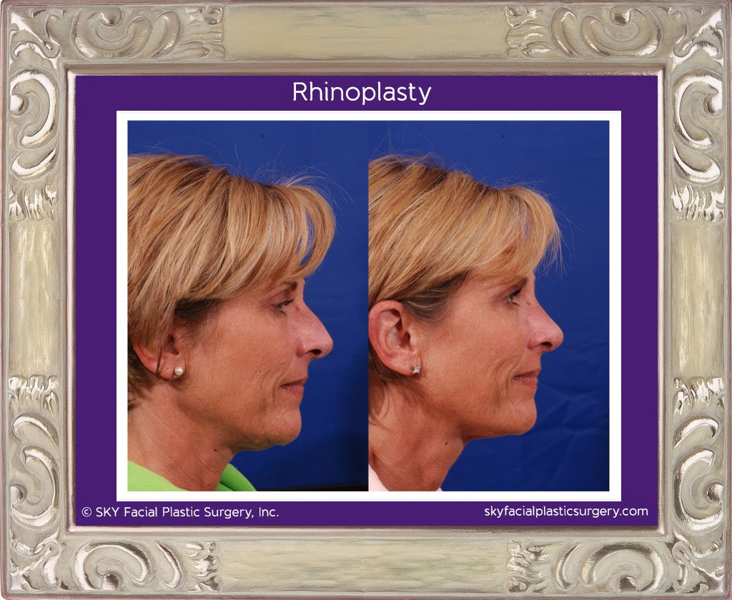 SKY-Facial-Plastic-Surgery-Rhinoplasty-11C.jpg