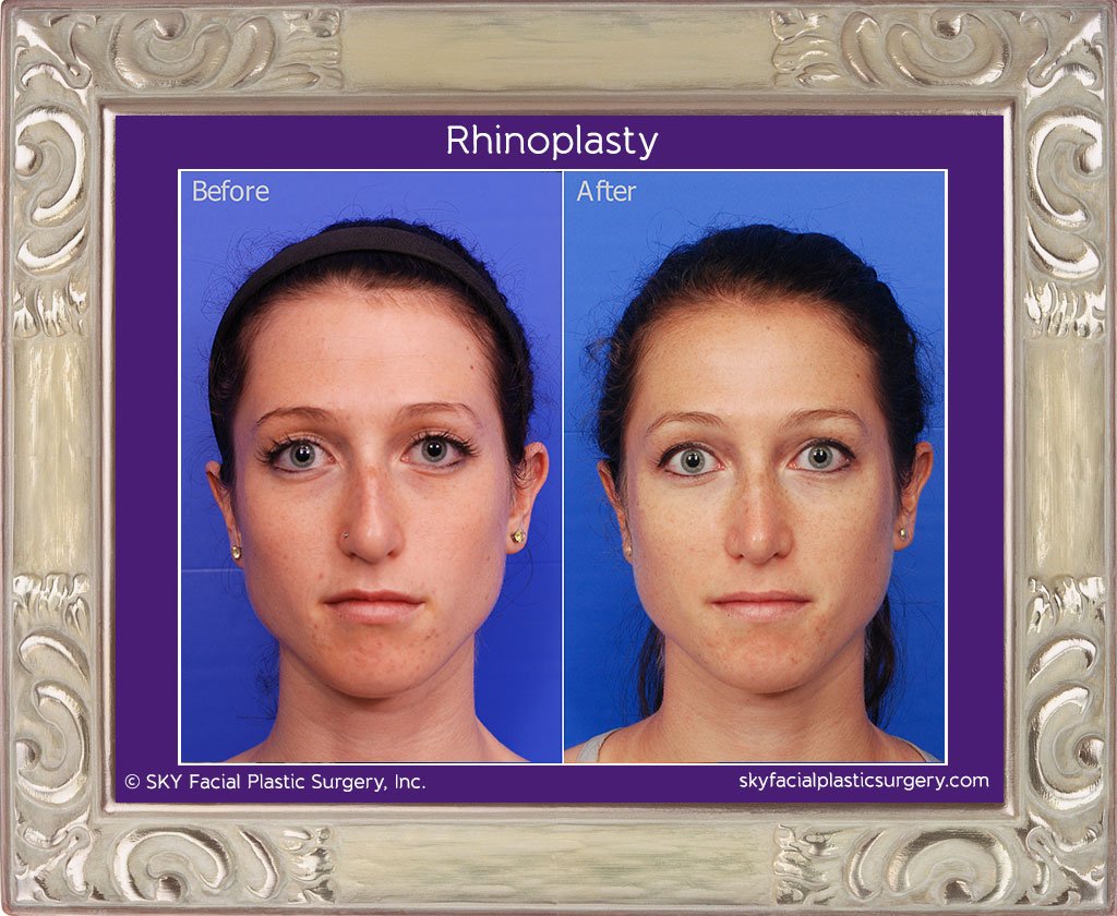 SKY-Facial-Plastic-Surgery-Rhinoplasty-12A.jpg