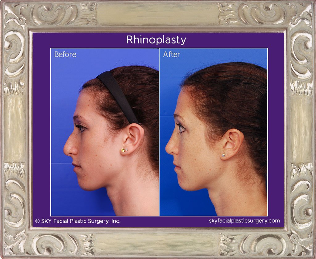 SKY-Facial-Plastic-Surgery-Rhinoplasty-12B.jpg