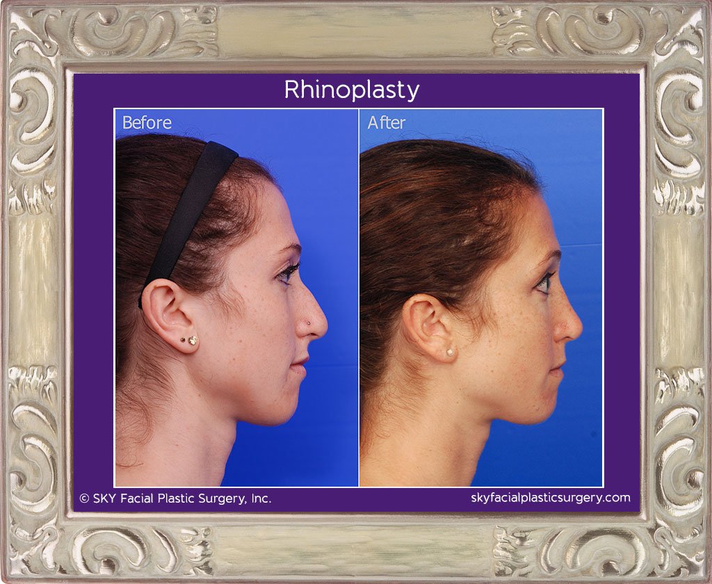 SKY-Facial-Plastic-Surgery-Rhinoplasty-12E.jpg
