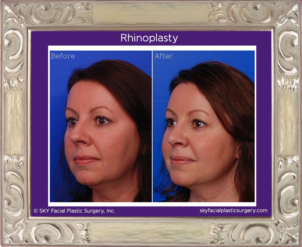 SKY-Facial-Plastic-Surgery-Rhinoplasty-13C.jpg