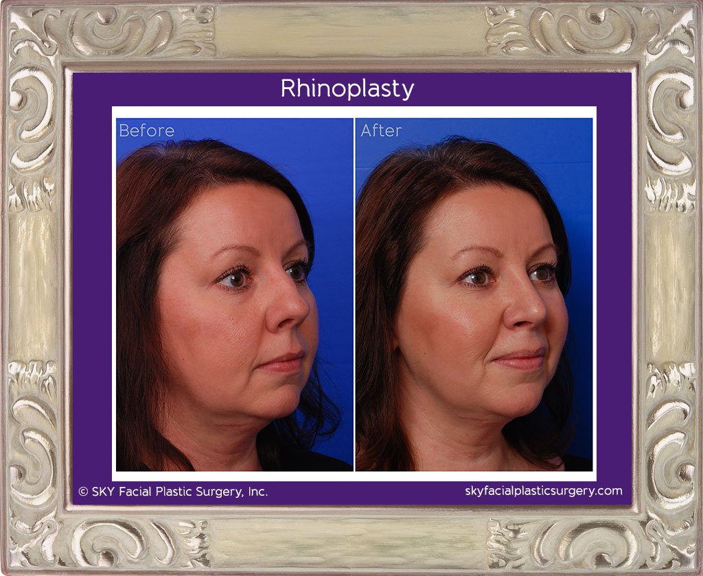 SKY-Facial-Plastic-Surgery-Rhinoplasty-13D.jpg
