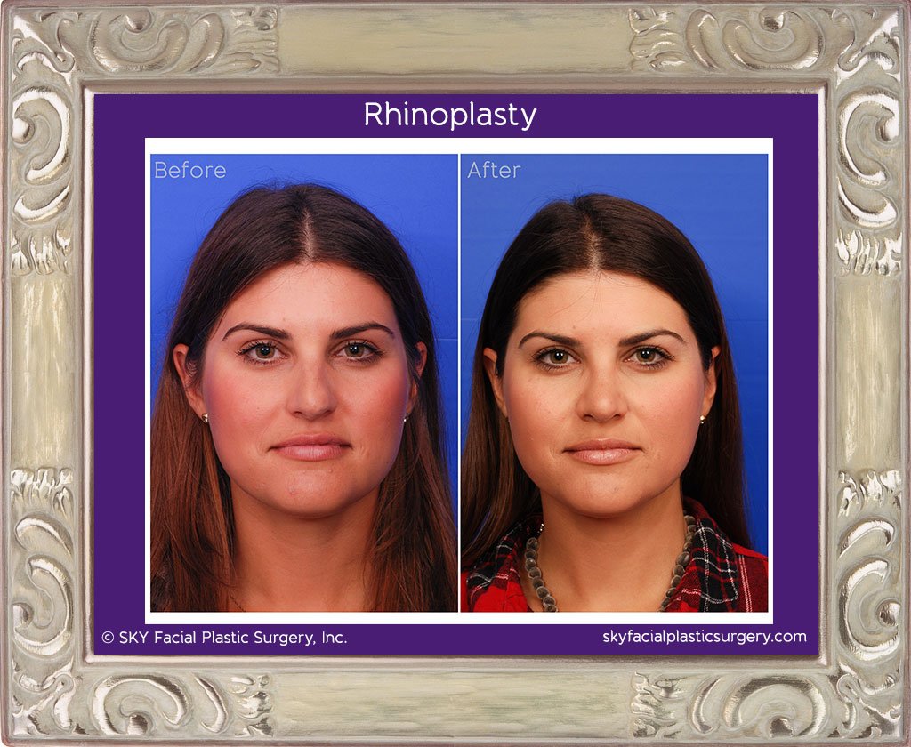 SKY-Facial-Plastic-Surgery-Rhinoplasty-14A.jpg