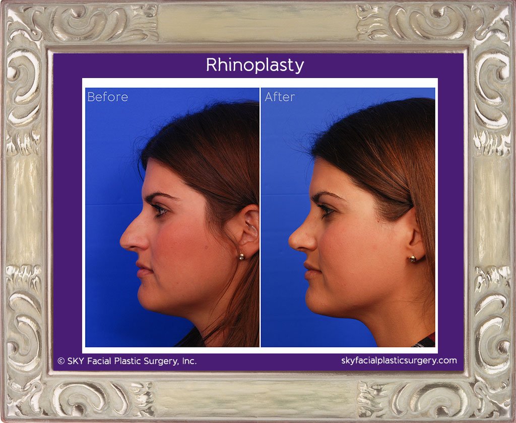 SKY-Facial-Plastic-Surgery-Rhinoplasty-14D.jpg
