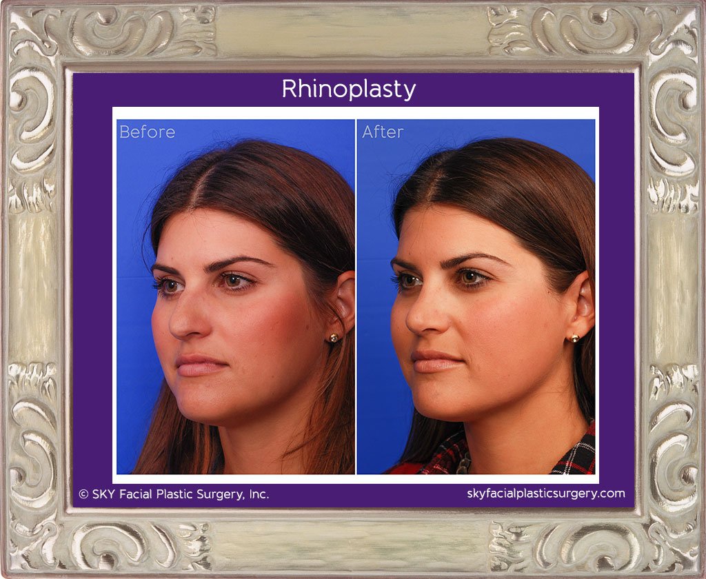 SKY-Facial-Plastic-Surgery-Rhinoplasty-14E.jpg