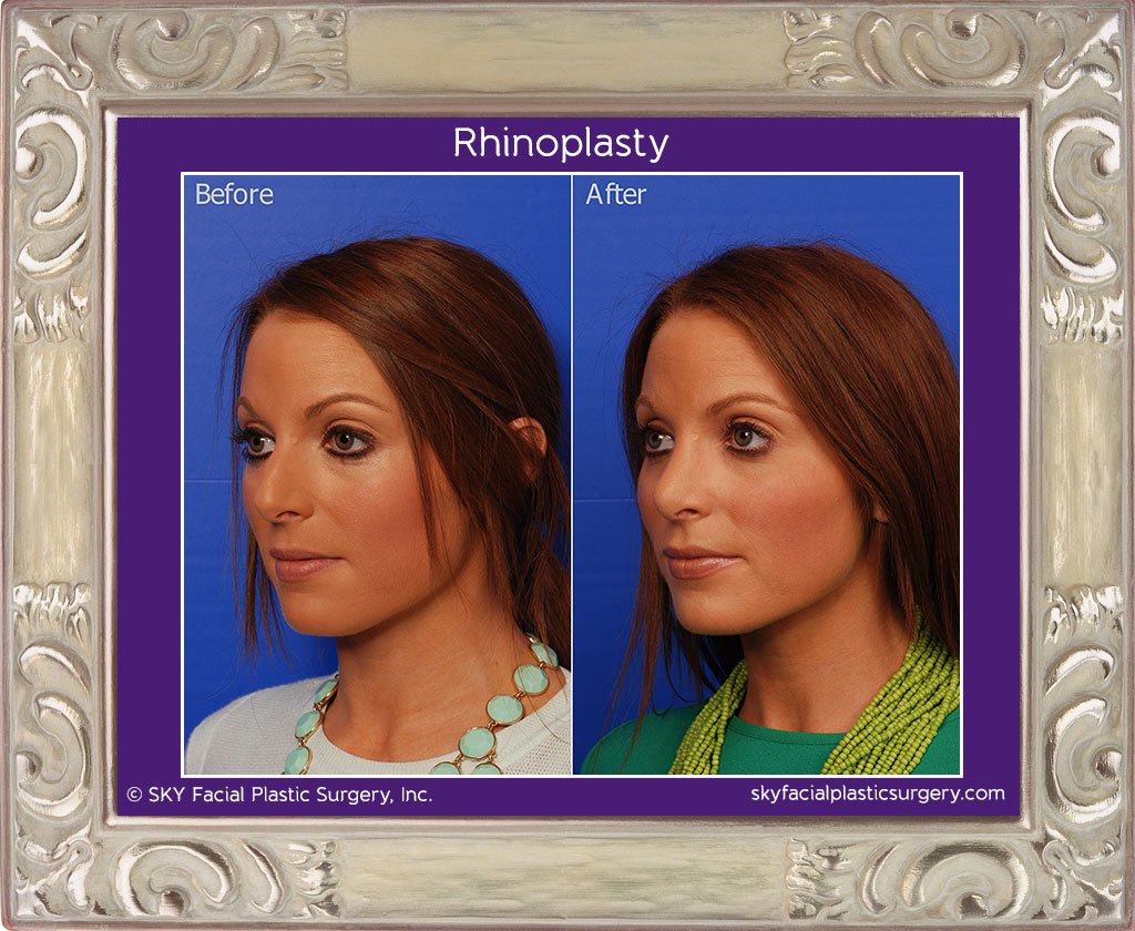 SKY-Facial-Plastic-Surgery-Rhinoplasty-15A.jpg