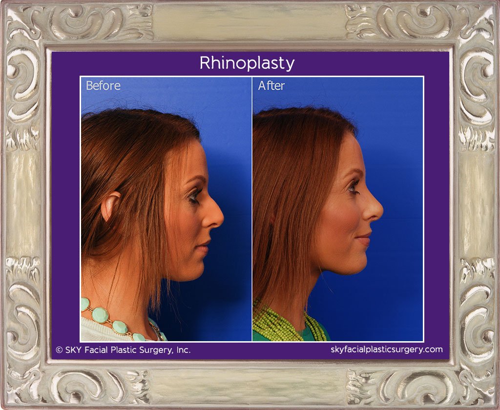 SKY-Facial-Plastic-Surgery-Rhinoplasty-15B.jpg