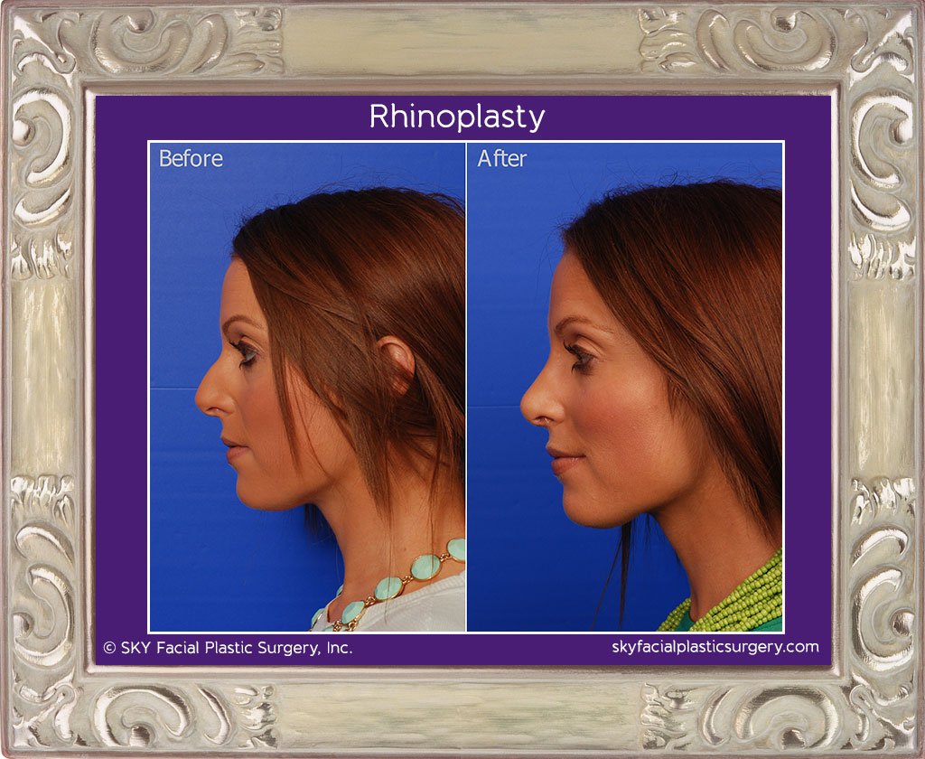 SKY-Facial-Plastic-Surgery-Rhinoplasty-15C.jpg