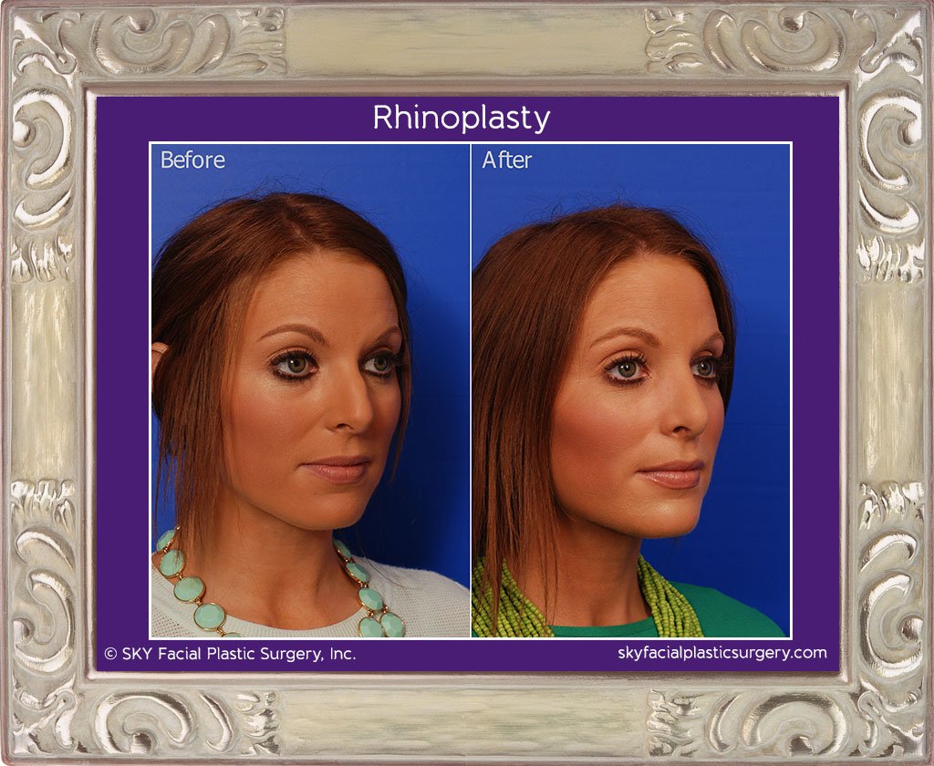 SKY-Facial-Plastic-Surgery-Rhinoplasty-15D.jpg
