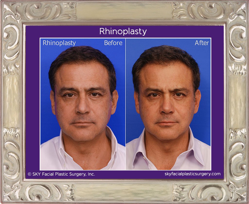 SKY-Facial-Plastic-Surgery-Rhinoplasty-16A.jpg