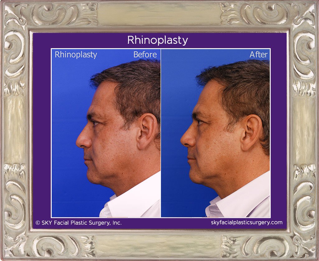 SKY-Facial-Plastic-Surgery-Rhinoplasty-16B.jpg