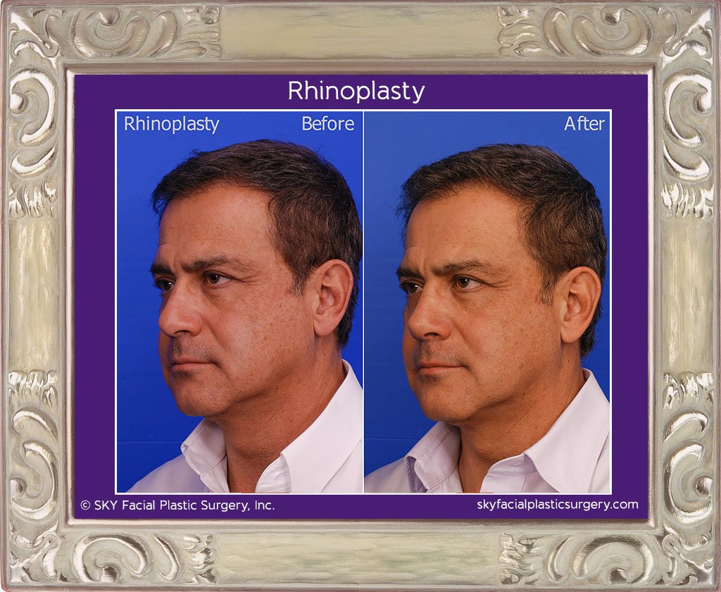 SKY-Facial-Plastic-Surgery-Rhinoplasty-16C.jpg